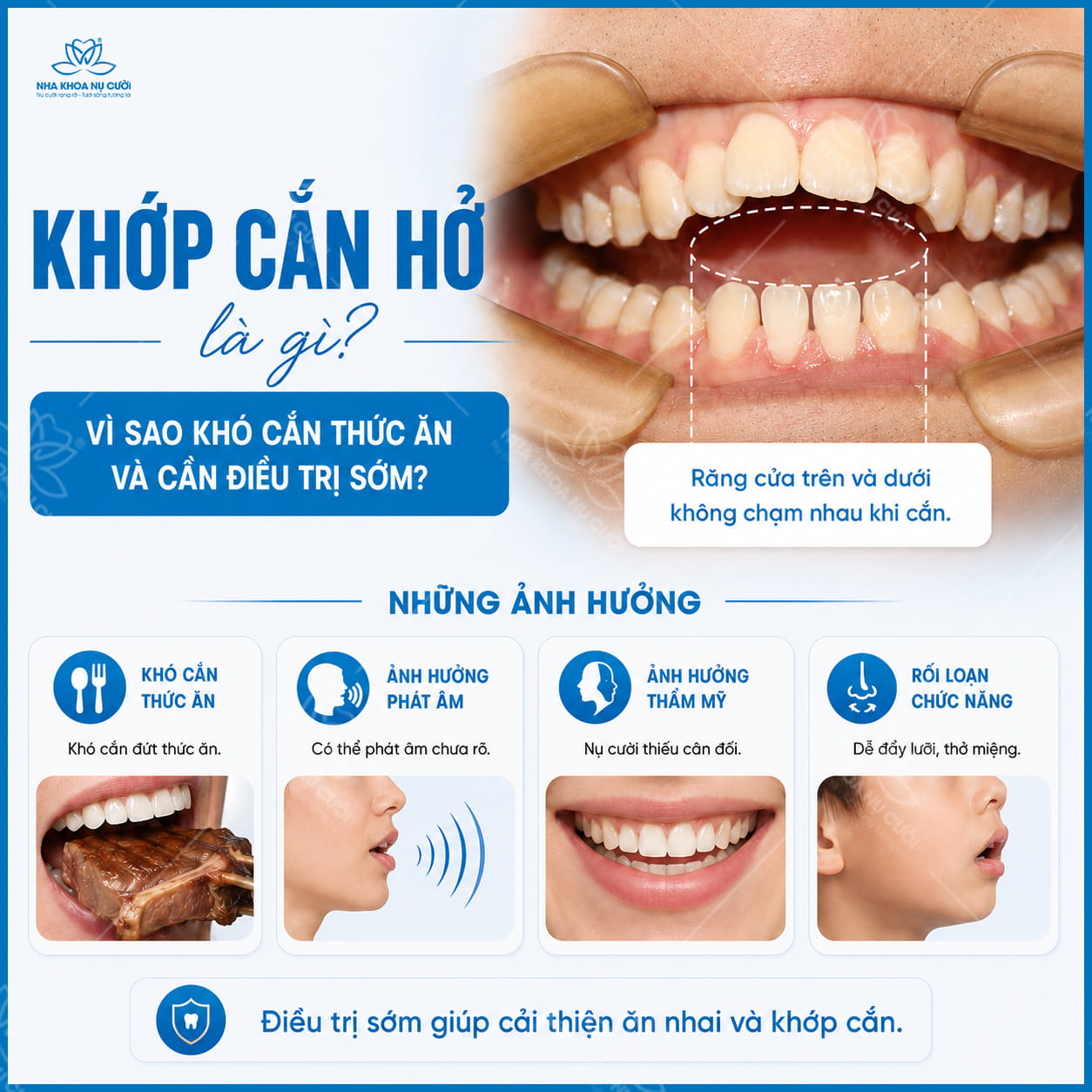 Khớp cắn hở là gì? Vì sao khó cắn thức ăn và cần điều trị sớm?