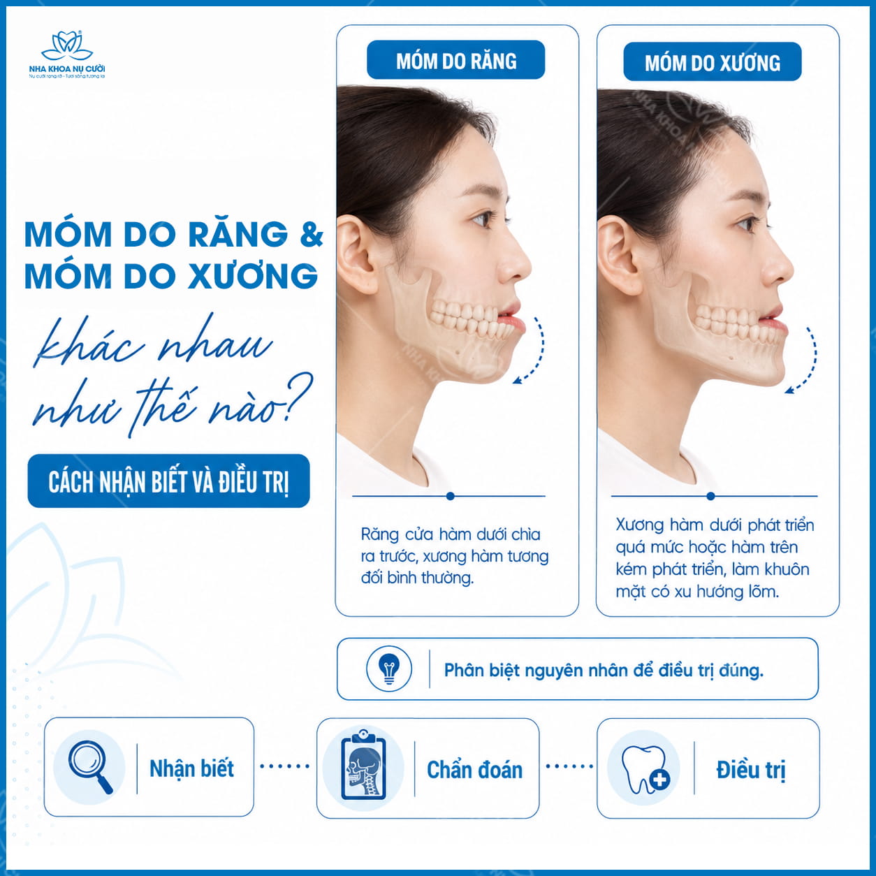 Móm do răng và móm do xương khác nhau như thế nào? Cách nhận biết và điều trị