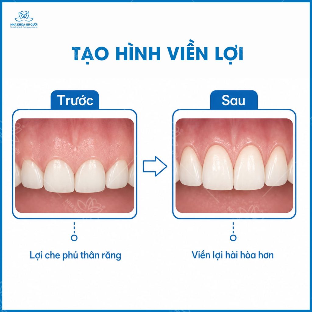 TAO-HINH-VIEN-LOI