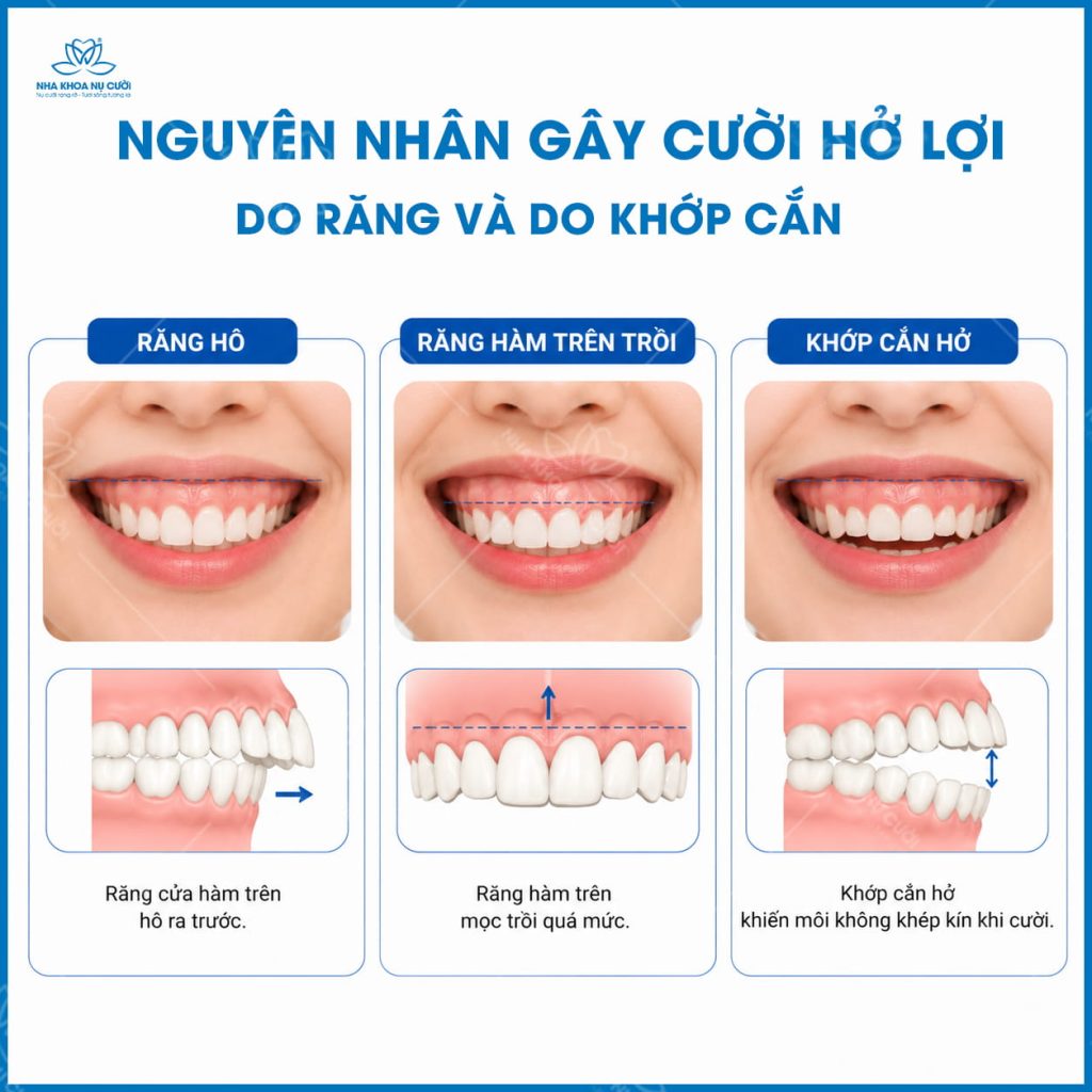 nguyen-nhan-gay-cuoi-ho-loi