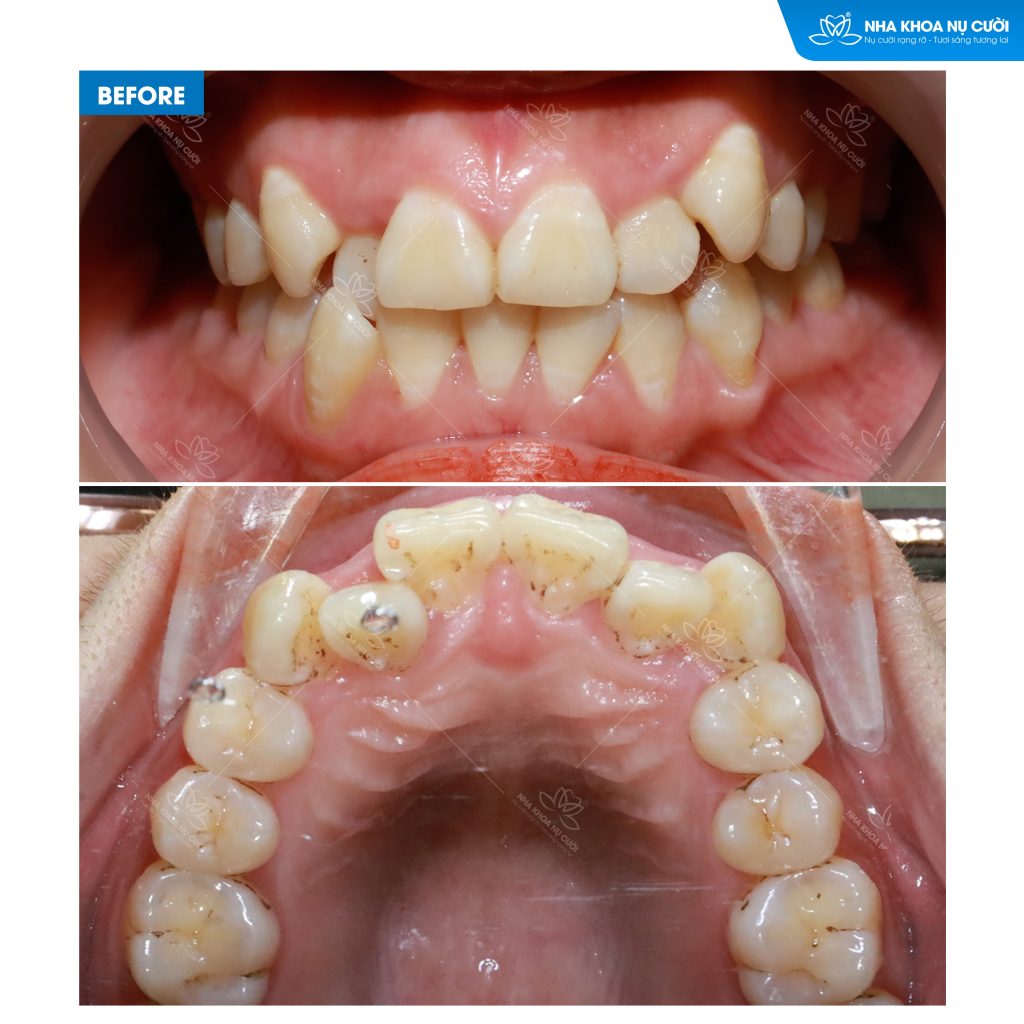 khach-hang-nieng-rang-invisalign