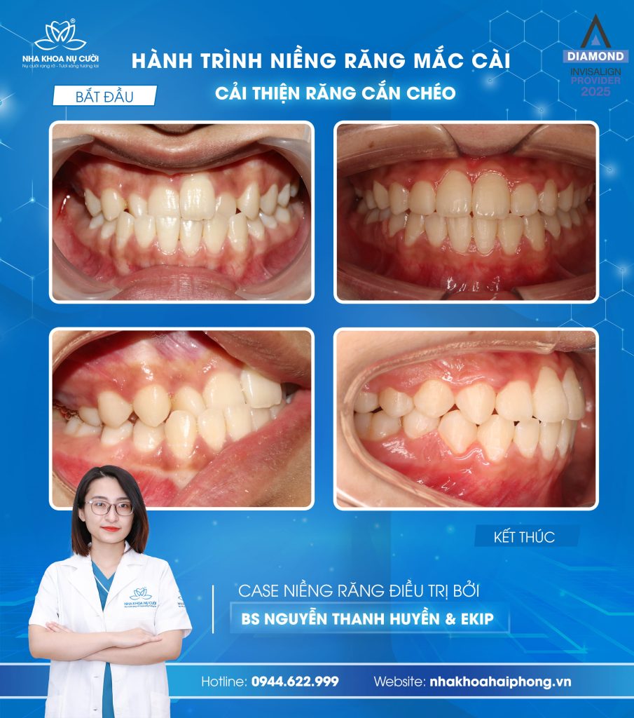 khop-can-cheo-hai-phong