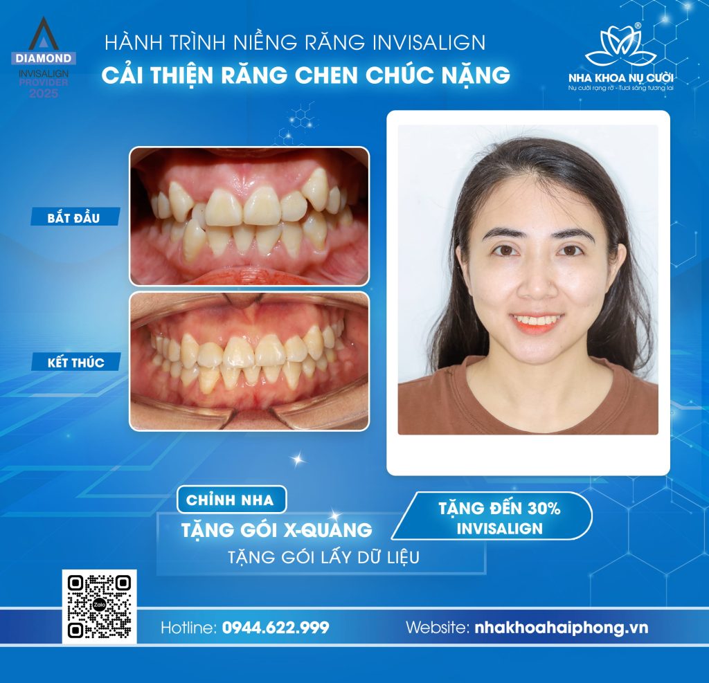 khach-hang-nieng-rang-invisalign