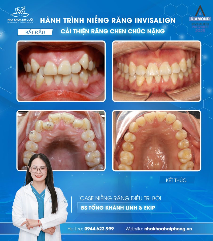 khach-hang-nieng-rang-invisalign