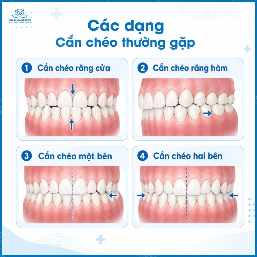 cac-dang-khop-can-cheo