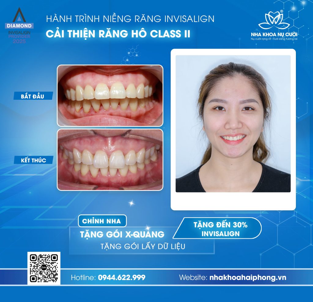 nieng-rang-invisalign-cai-thien-rang-ho-classII