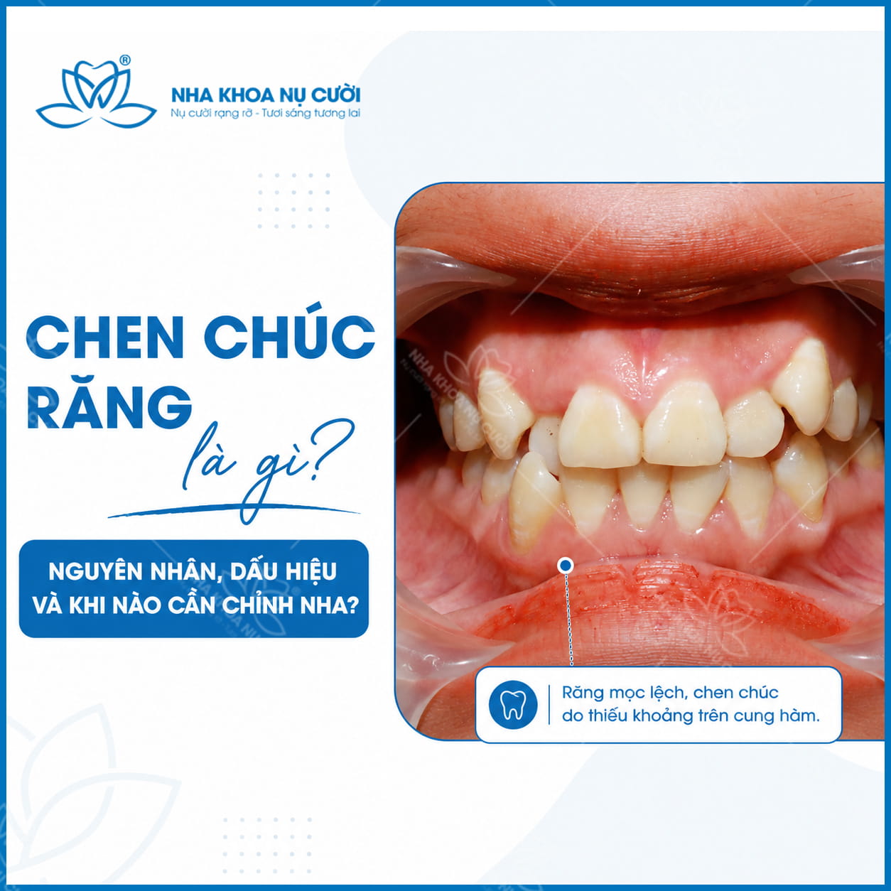 Chen chúc răng là gì? Nguyên nhân, dấu hiệu và khi nào cần chỉnh nha?