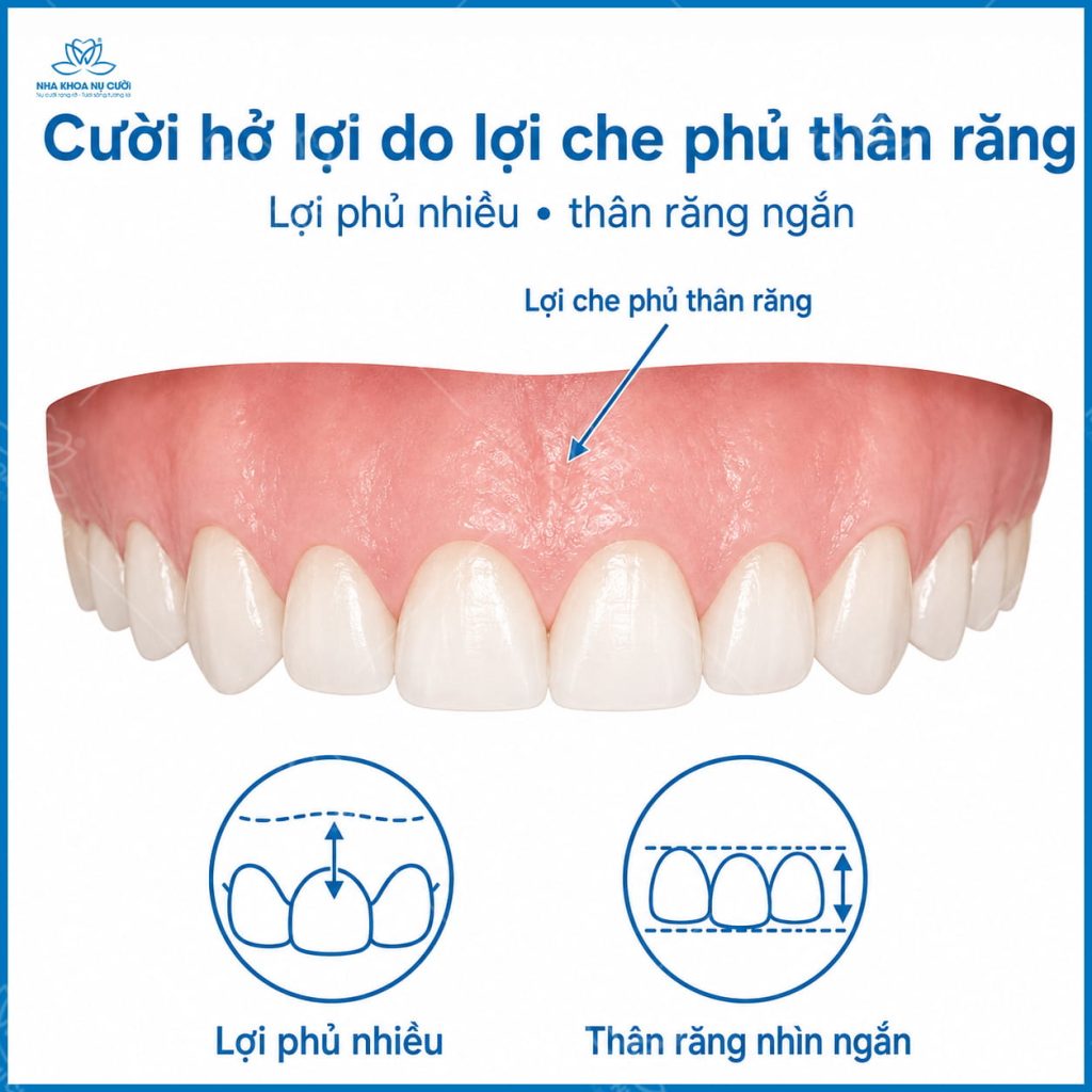 nguyen-nhan-gay-cuoi-ho-loi