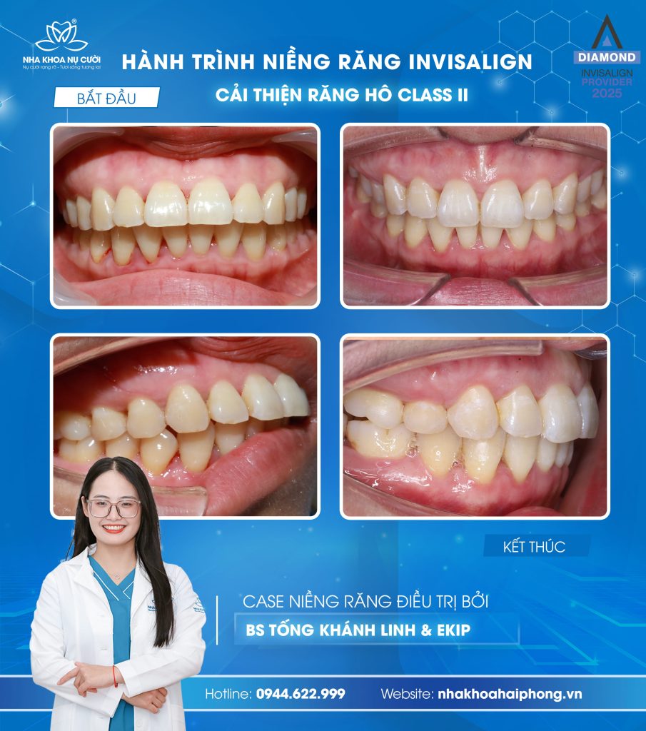 nieng-rang-invisalign-cai-thien-rang-ho-classII