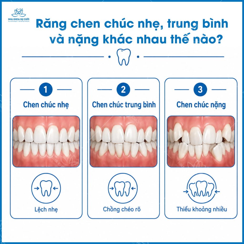 chen-chuc-rang-hai-phong