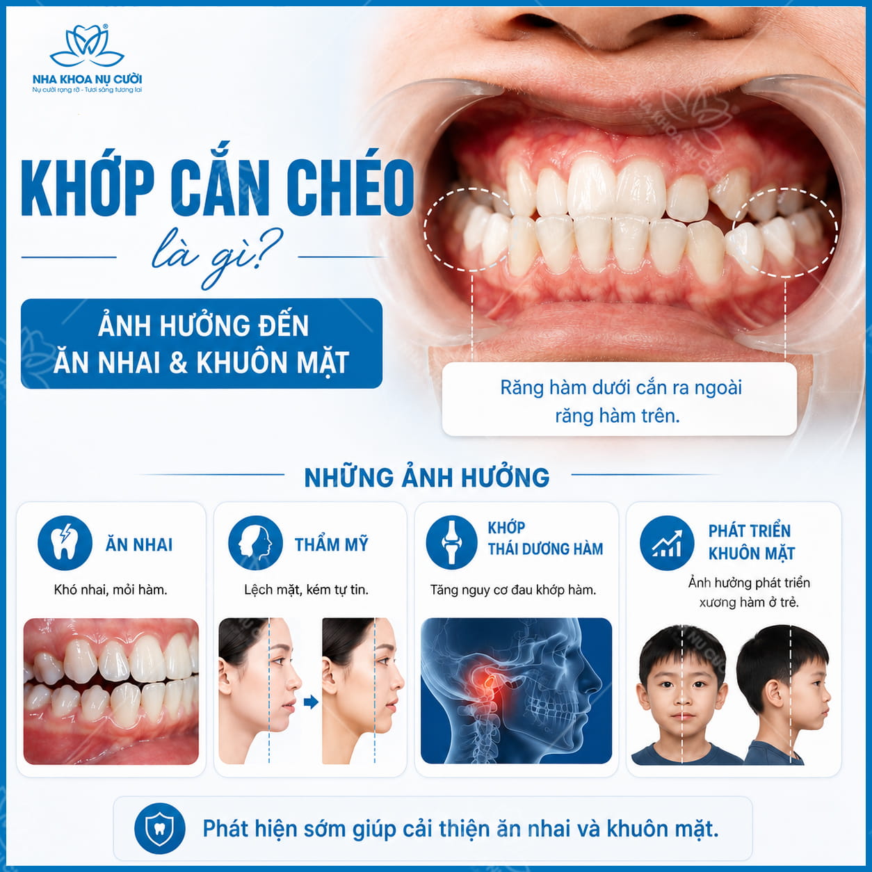 Khớp cắn chéo là gì? Những ảnh hưởng đến ăn nhai và sự phát triển khuôn mặt