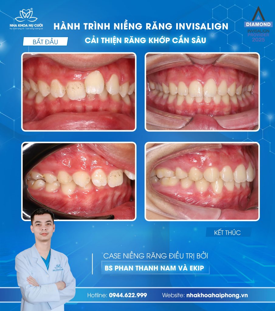 dieu-tri-khop-can-sau-tai-nha-khoa-nu-cuoi